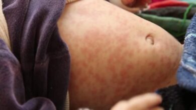افزایش ۶۰ درصدی سرخک در غور؛ 6 مورد مرگ ثبت شد 1 measles disease
