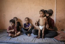 AA 20250714 38554714 38554695 MALNUTRITION CRISIS DEEPENS FOR CHILDREN IN GAZA UNDER ISRAELI BLOCKADE 1
