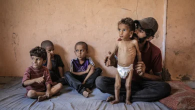 AA 20250714 38554714 38554695 MALNUTRITION CRISIS DEEPENS FOR CHILDREN IN GAZA UNDER ISRAELI BLOCKADE 1