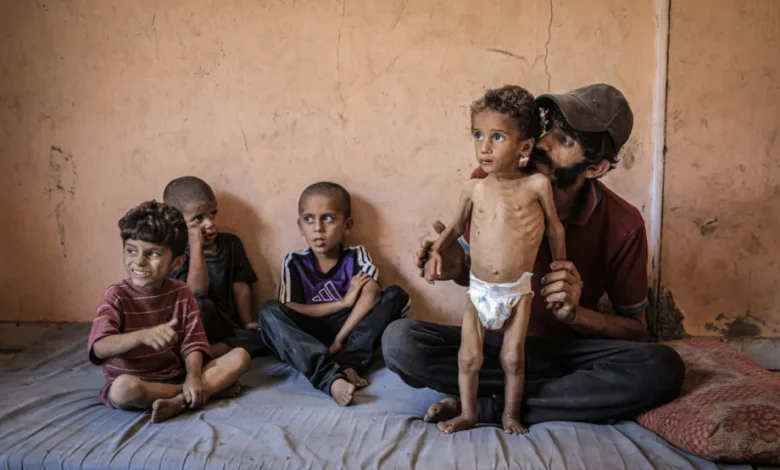 AA 20250714 38554714 38554695 MALNUTRITION CRISIS DEEPENS FOR CHILDREN IN GAZA UNDER ISRAELI BLOCKADE 1